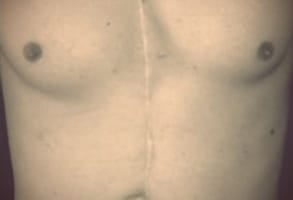 Photo of Global Seducer Sebastian Harris' scarred chest
