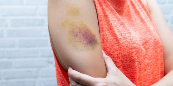 Photo of a bruised arm Photo of a bruised arm